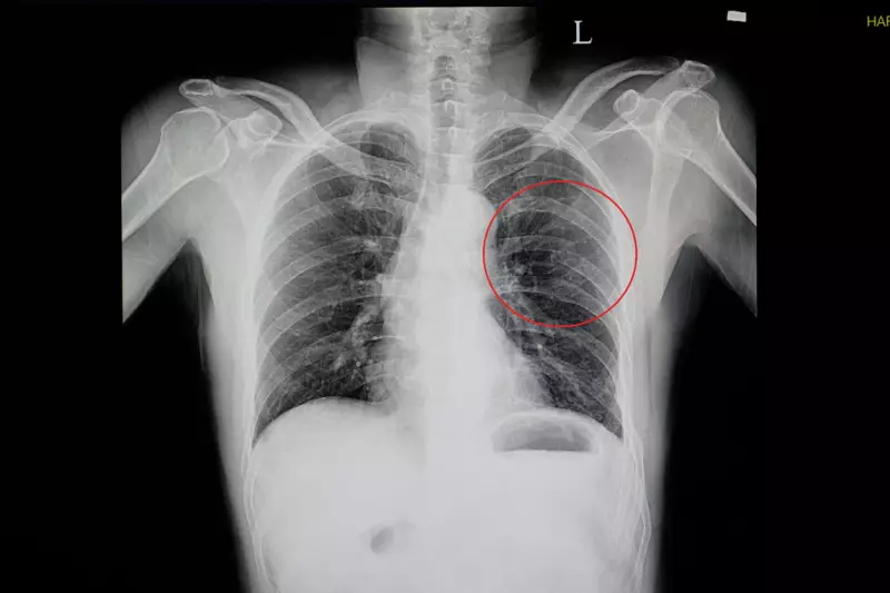 Chest Trauma